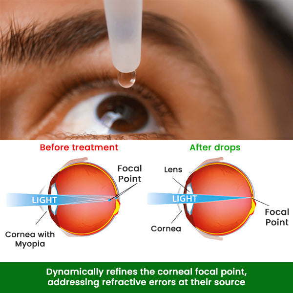 🔥Hot Sales - 50% OFF🔥Cvreoz® Myopia Cure Drops