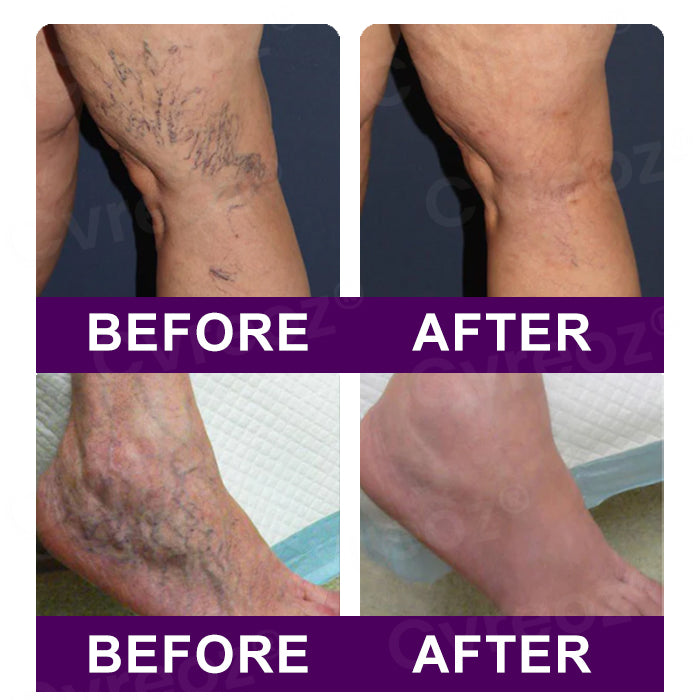 🔥Hot Sales - 50% OFF🌿Cvreoz® Polidocanol Nano Patches for Varicose Veins