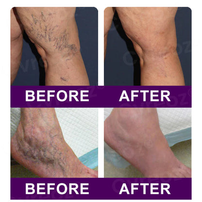🔥Hot Sales - 50% OFF🌿Cvreoz® Polidocanol Nano Patches for Varicose Veins