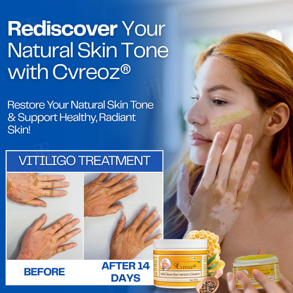 13 Pieces LEFT!!.. Cvreoz® VitiClear Bee Venom Cream