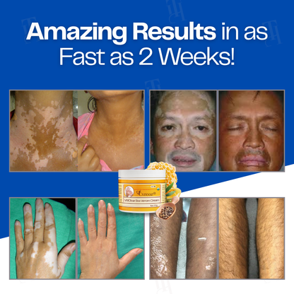 13 Pieces LEFT!!.. Cvreoz® VitiClear Bee Venom Cream