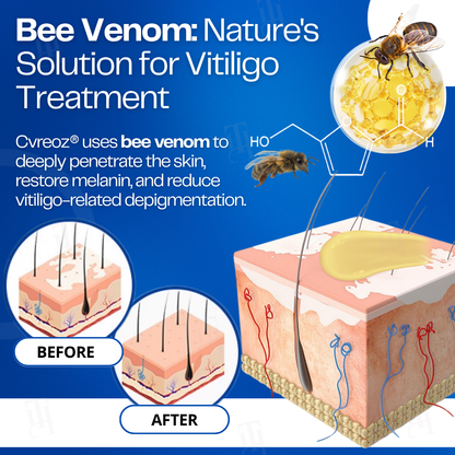 13 Pieces LEFT!!.. Cvreoz® VitiClear Bee Venom Cream
