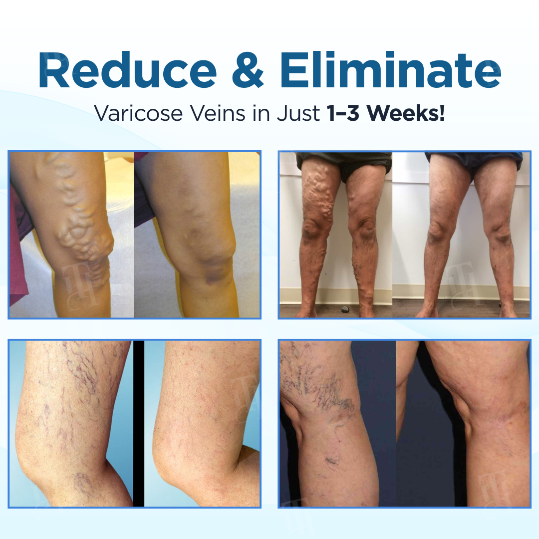 🔥Hot Sales - 50% OFF🌿Cvreoz® Herbal Varicose Veins Treatment Spray