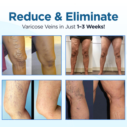 🔥Hot Sales - 50% OFF🌿Cvreoz® Herbal Varicose Veins Treatment Spray